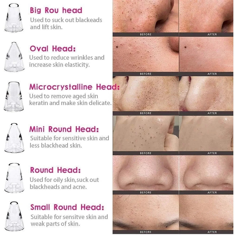 6-in-1 Multi-Functional Blackhead & Pore | Vacuum Suction Technology