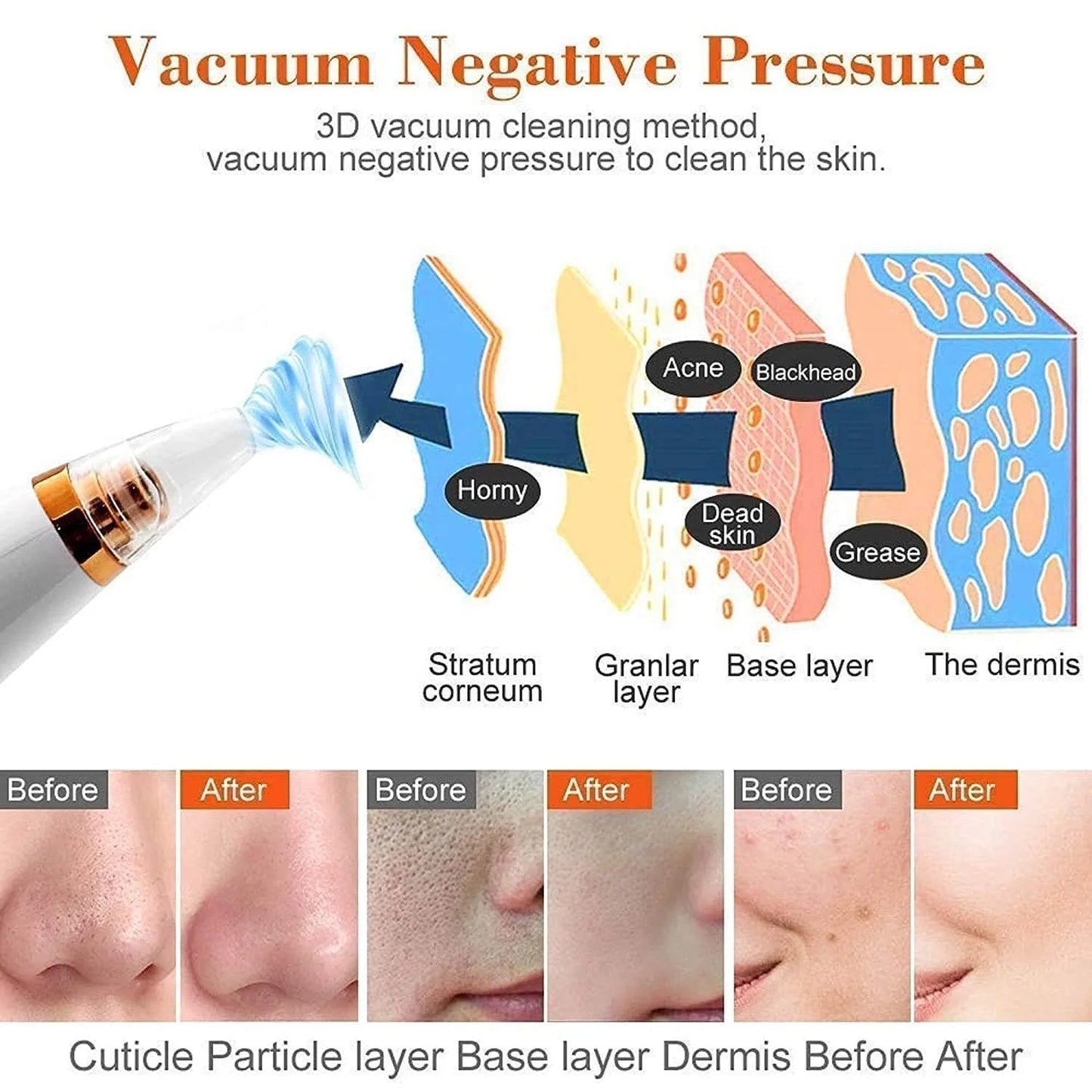 6-in-1 Multi-Functional Blackhead & Pore | Vacuum Suction Technology